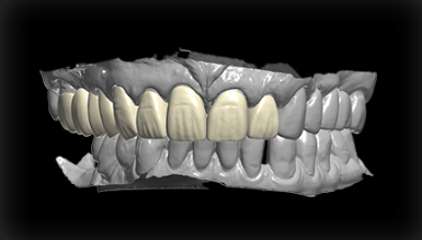 Full Contour Bridge 1
