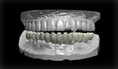 Full Contour Bridge 2