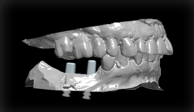 Implants Abutment 1