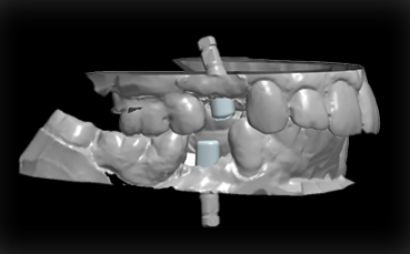 Implants Abutment 2