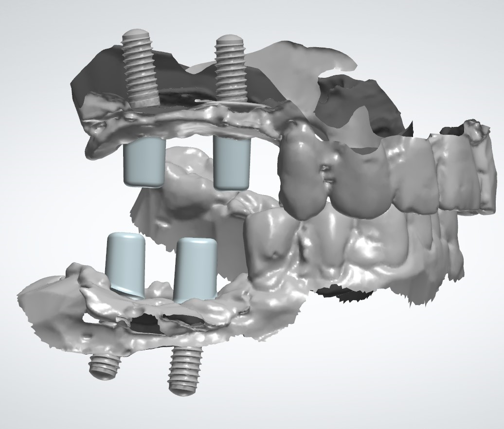 Implant Restorations