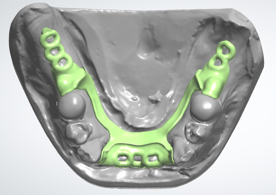 RPD & Denture Frameworks